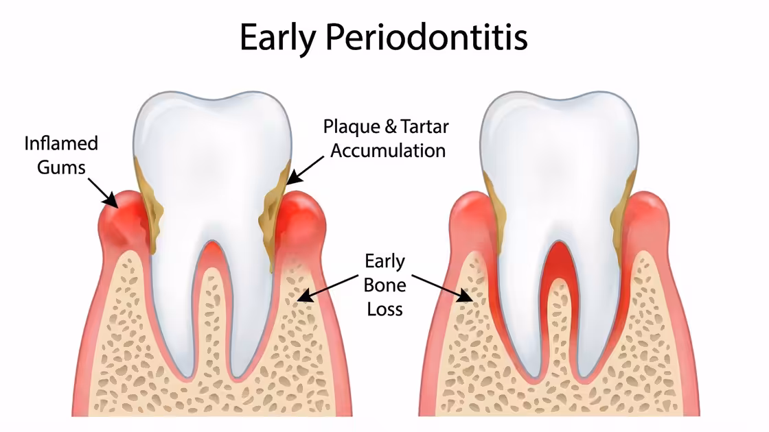 Early Periodontitis