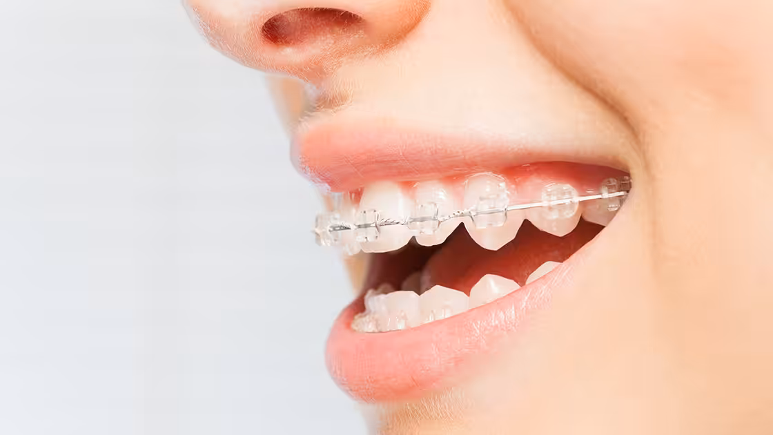 Clear brackets patient smile