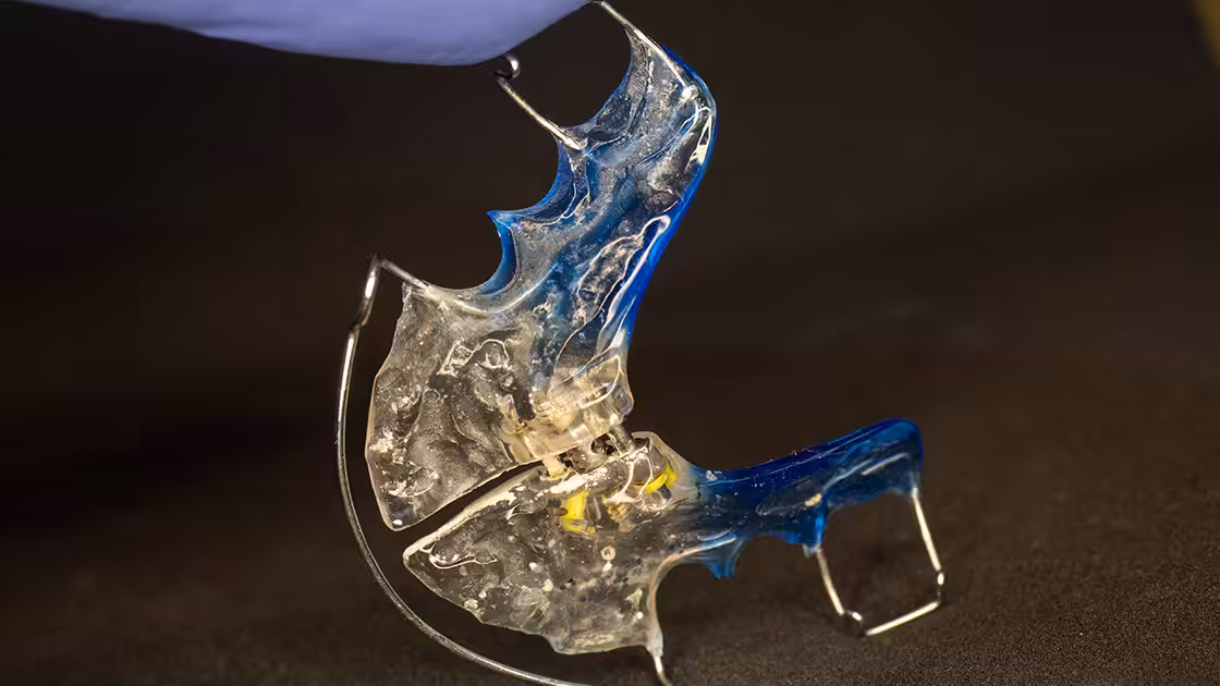 Palatal expander device closeup