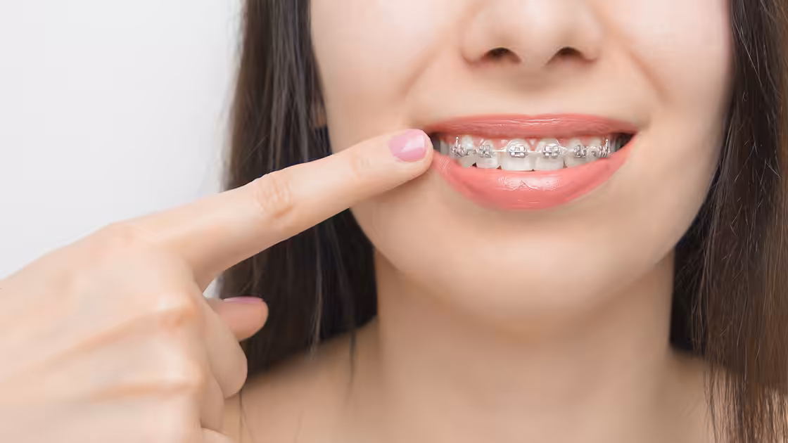 Self ligating braces patient pointing
